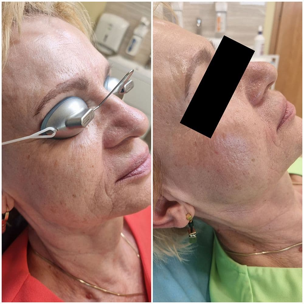 3d_rejuv_fotona.jpg