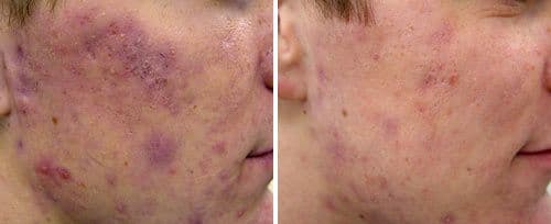 active_acne3_sult_rn.jpg