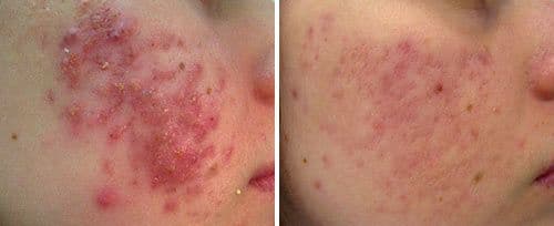 active_acne4_dr_radulaski.jpg